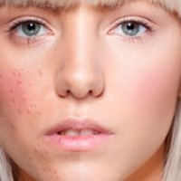 Маски для лица от прыщей: показания, свойства, рецепты, видео-советы