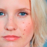 Лучшие маски от прыщей на лбу – как сделать кожу идеальной в домашних условиях?