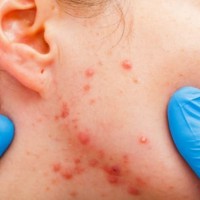 Внутренние прыщи на лице: как избавиться? Советы косметологов, профилактика внутренних прыщей